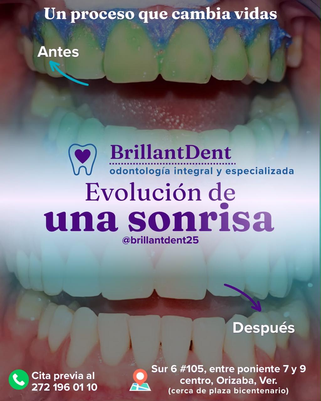 Antes y después de mejora estética dental