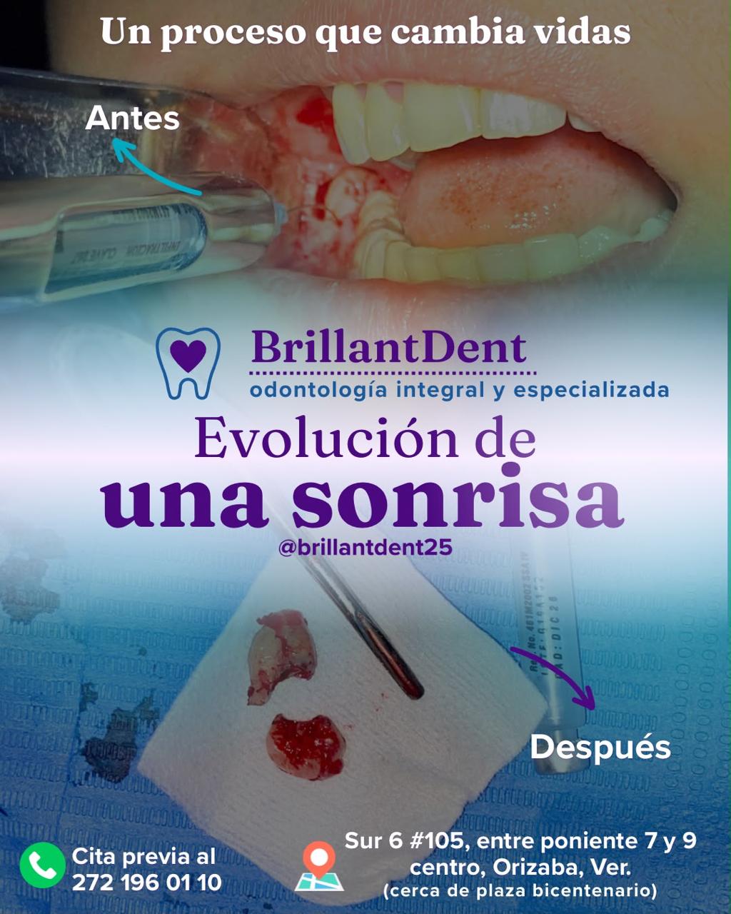 Caso clínico de extracción dental en BrillantDent