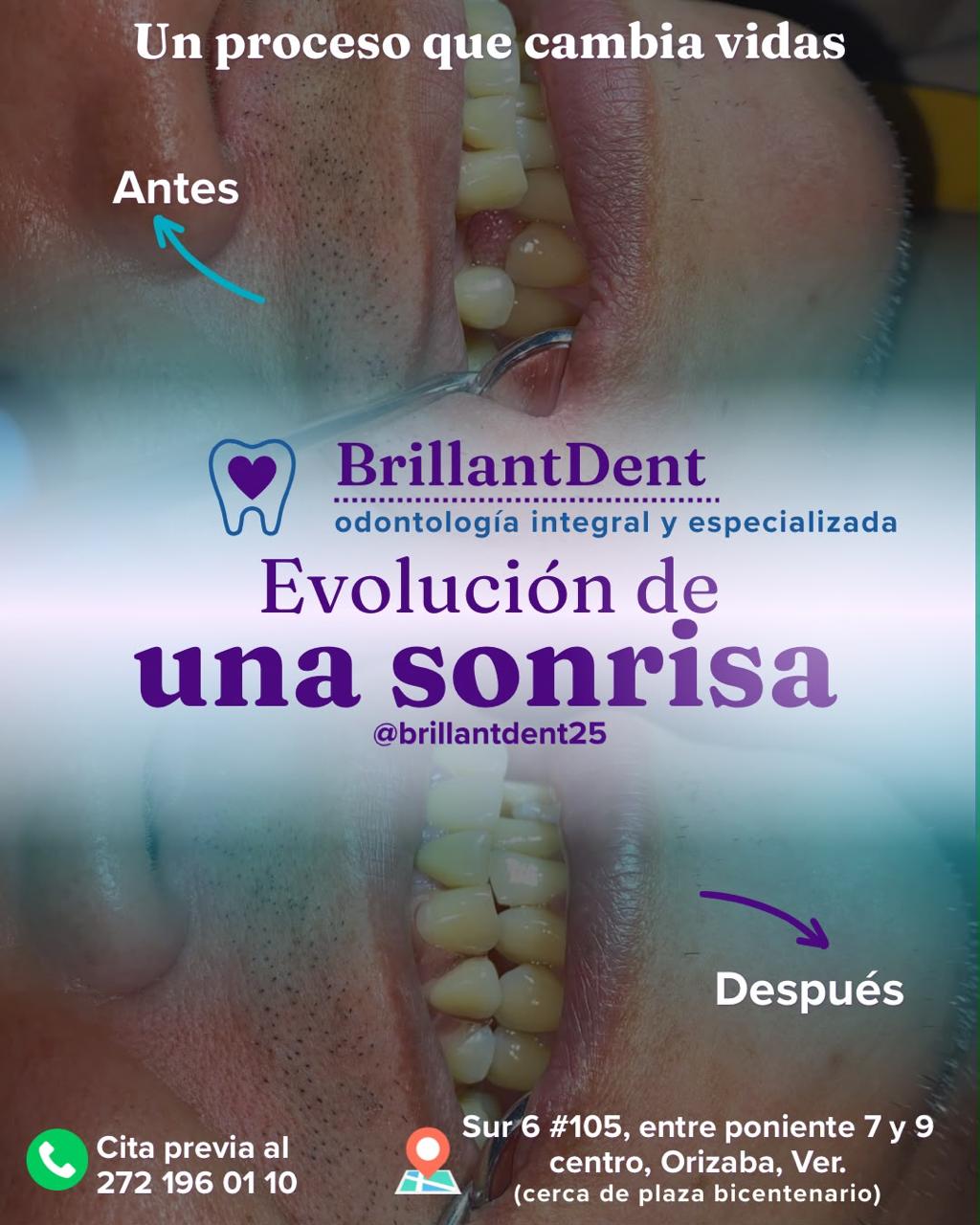 Antes y después de rehabilitación dental posterior