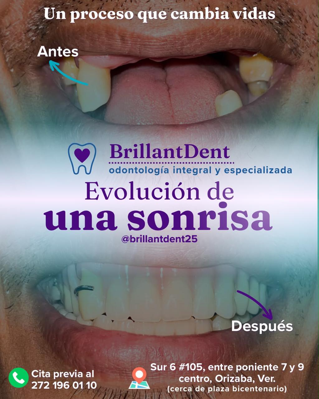 Antes y después de rehabilitación protésica dental