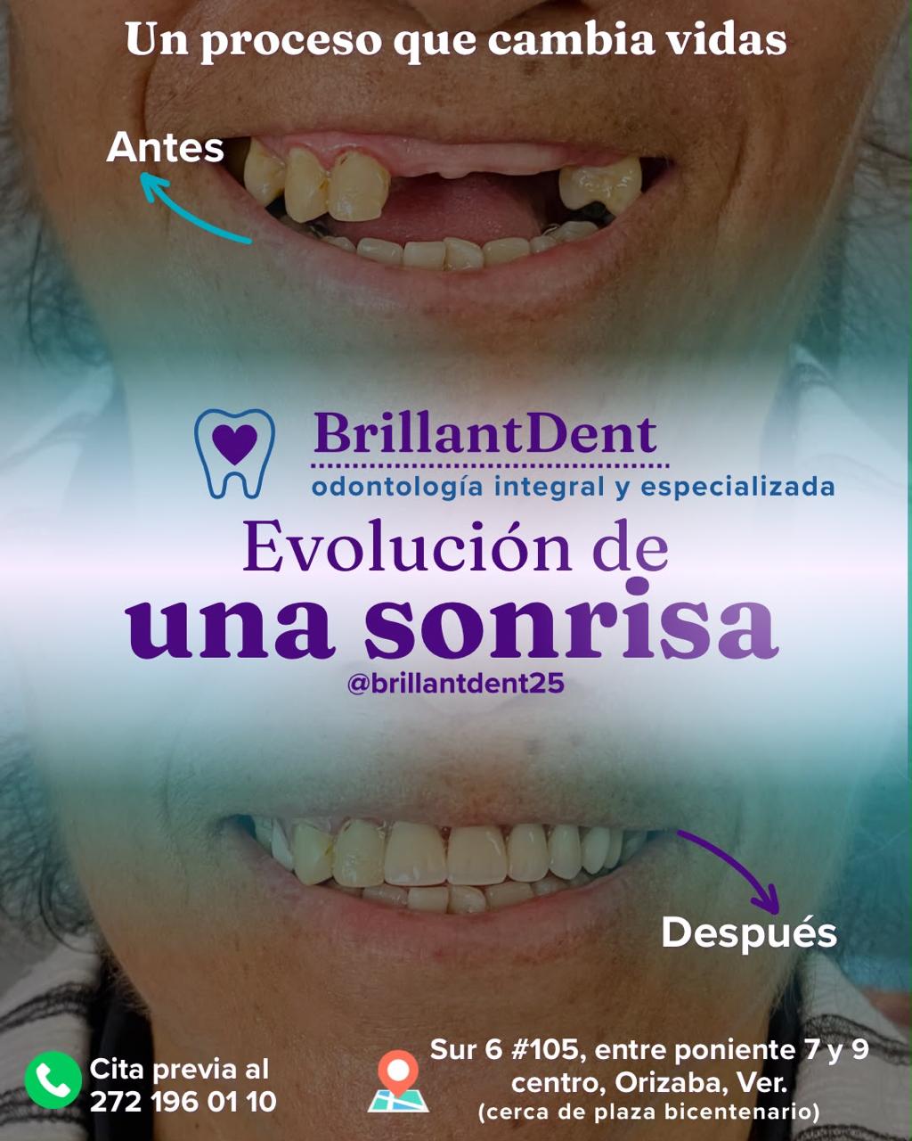 Antes y después de rehabilitación dental en BrillantDent